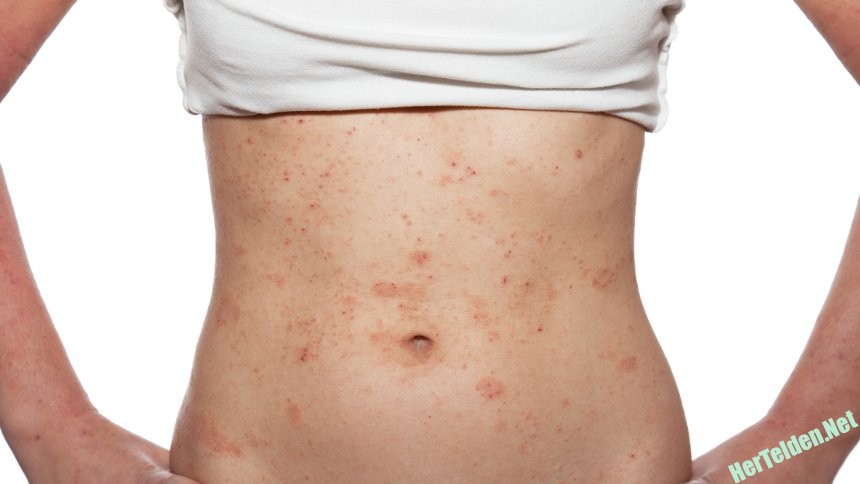 Neurodermitis-Dermatit Nedir?Nasıl Tedavi Edilir? Neurodermitis