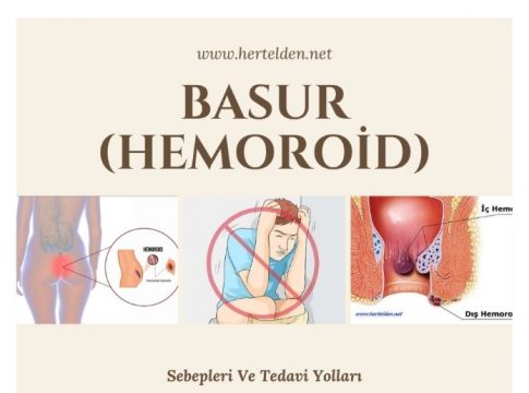 Basur Sebepleri tedavisi
