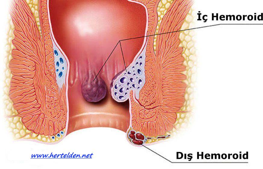 iç dış hemoroid