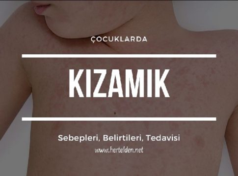 Çocuklarda Kızamık Belirtileri, Tedavisi