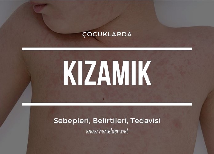 Çocuklarda Kızamık Belirtileri, Tedavisi Çocuklarda Kızamık Belirtileri, Tedavisi