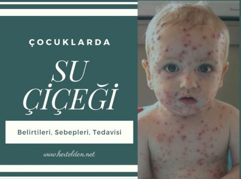Su Çiçeği Tedavisi