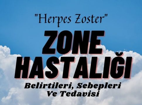 herpes zoster