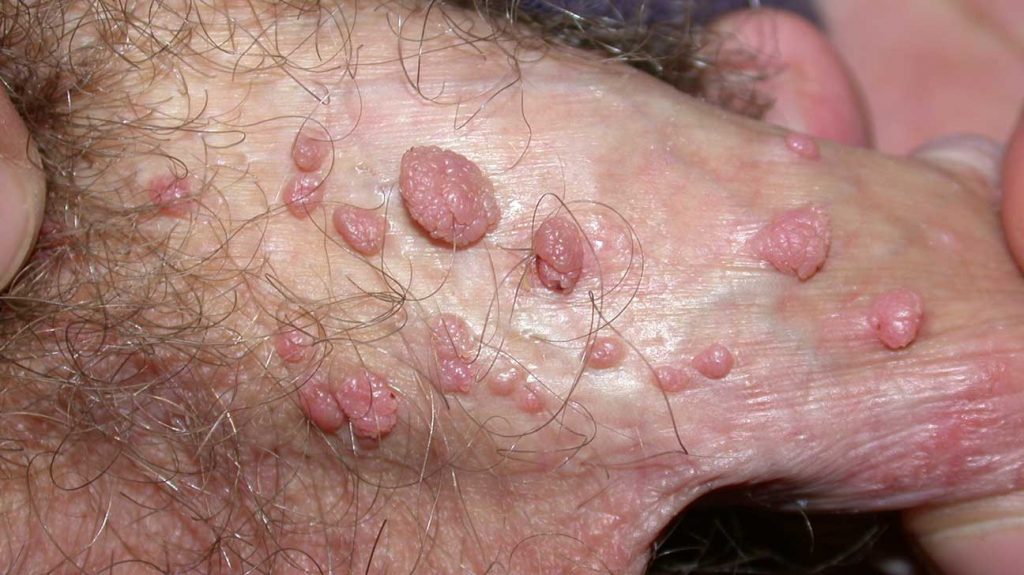 Genital Siğil
