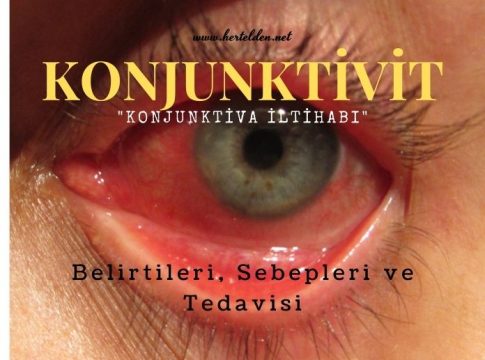 Konjunktiva iltihabı