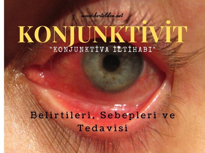 Konjunktiva İltihabı (konjunktivit) Konjunktiva iltihabı
