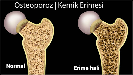 Osteoporoz Nedir? | Hertelden.Net