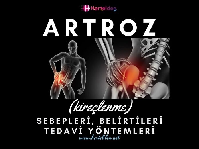 Artroz Nedir? Belirtileri, Nedenleri, Tedavisi Artroz Nedir ? | Hertelden.Net