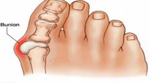 Gut hastalığı Neden Olur? | Hertelden.Net