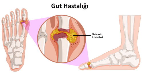 Damla Hastalığı | Hertelden.Net