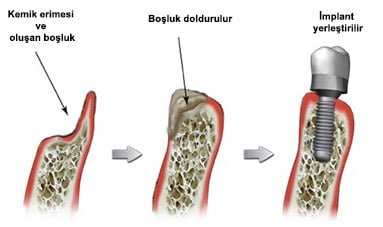 Kemik Erimesi Çözümü | Hertelden.Net