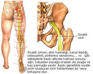 Siyatik Nedenleri